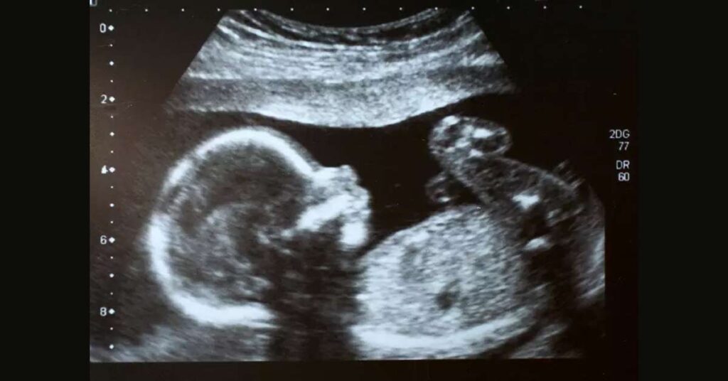 Como Estimar o Peso Fetal Através de Ultrassom_ Uma Calculadora Simples